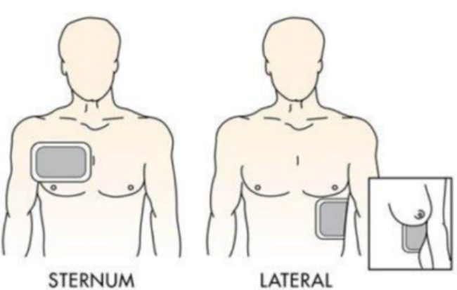 ขั้นตอนการใช้งานเครื่อง AED สำหรับผู้ใหญ่